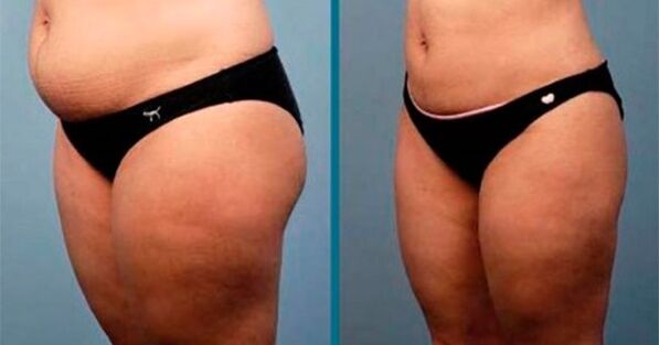 ayda 10 kiloqram arıqlamaq üsulları